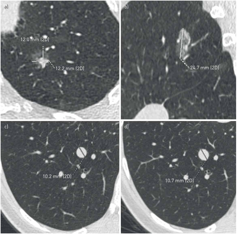FIGURE 1 Limitations of two-dimensional (2D) measurements. The axial diameter may not be the maximum one in the evaluation of lung nodules. a) A small part-solid nodule in the apico-posterior segment of the left upper lobe, with a maximum axial diameter of 12×12.2 mm; b) the sagittal multiplanar reconstruction shows that the largest diameter of the same nodule is the sagittal one of 24.7 mm. The multiplanar evaluation of nodule diameter is especially important to document asymmetrical growth of nodules. c), d) The low level of agreement when measuring small nodules: for the same nodule in the right lower lobe two different diameter values have been reported by two readers. Considering the nearest whole diameter of the two values, it results in 1 mm difference in the maximum diameter, a significant difference when considering small nodules.