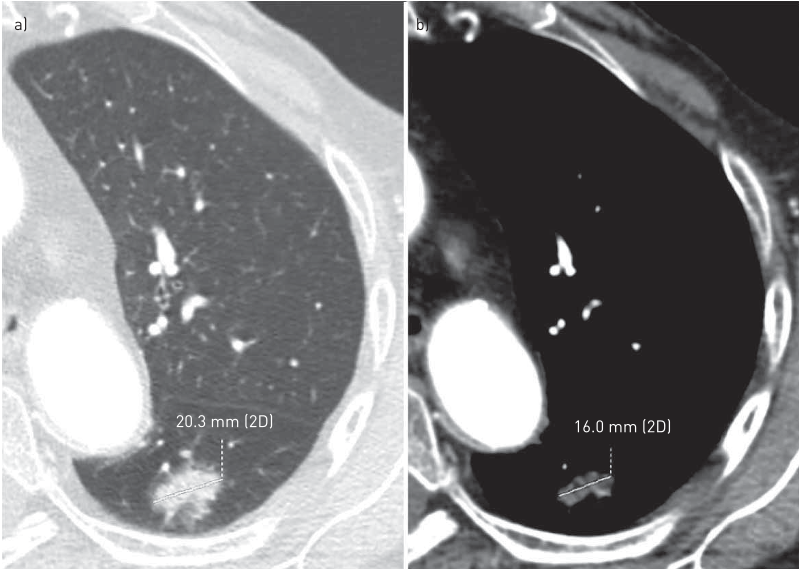 FIGURE 2 Disagreement in measuring the solid portion of a part-solid nodule when using different reconstruction algorithms and window settings. A part-solid nodule in the apical segment of left lower lobe is shown. a) By using a high-spatial frequency algorithm and the lung window, the measured maximum axial diameter of the solid portion of the nodule corresponds to 20.3 mm; b) by using a smooth algorithm and the mediastinal window, the measured maximum axial diameter of the solid portion of the nodule corresponds to 16 mm. 2D: two-dimensional.