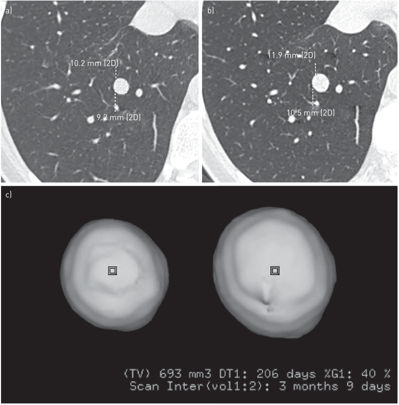 FIGURE 3 Volume evaluation during follow-up allows the detection of nodule growth over a shorter period of time compared to diameter estimation. a) Computed tomography (CT) axial image shows the same nodule located in the right lower lobe as reported in figure 1c; b) a 3-month follow-up axial CT image demonstrates minimal change in nodule diameters; c) conversely, nodule volume calculation using a three-dimensional (3D) volumetric method demonstrates a significant increase in volume within the range of malignancy. Histopathology revealed a carcinoid tumour. 2D: two-dimensional; TV: total volume; DT: volume doubling time; %G: volume increase; scan inter: scan interval. Squares in the nodule represent the starting points of the 3D analysis.